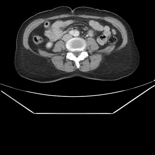 File:Aortic dissection (Radiopaedia 25350-25604 C 72).jpg