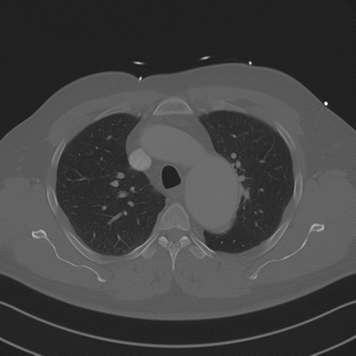 Aortic dissection (Radiopaedia 50763-56234 Axial bone window 37).png
