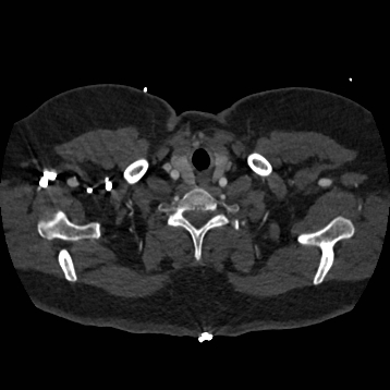 Aortic dissection (Radiopaedia 57969-64959 A 13).jpg