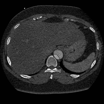Aortic dissection (Radiopaedia 57969-64959 A 275).jpg