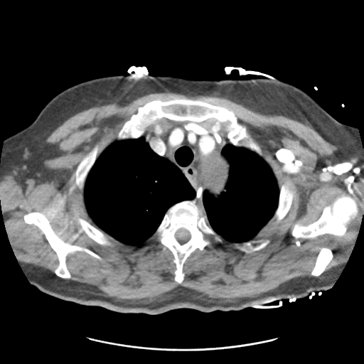 Aortic dissection - Stanford type B (Radiopaedia 50171-55512 A 9).png