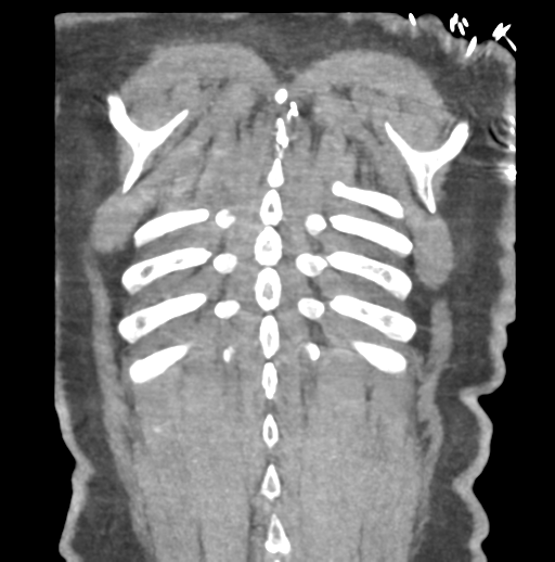 File:Aortic dissection - Stanford type B (Radiopaedia 50171-55512 B 78).png