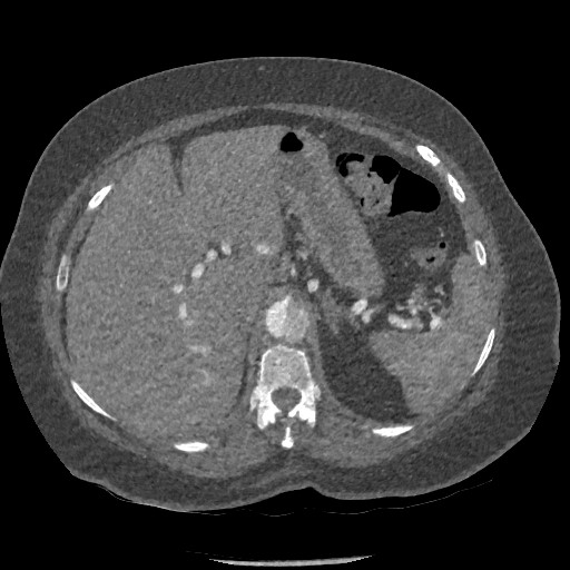Aortic dissection - Stanford type B (Radiopaedia 88281-104910 A 98).jpg