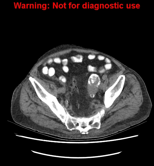 File:Aortic graft infection (Radiopaedia 44979-48907 Axial non-contrast 78).jpg