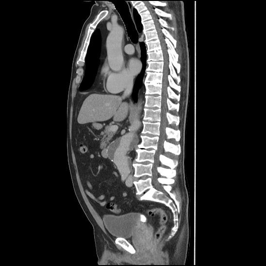 Aortic intramural hematoma (type B) (Radiopaedia 79323-92387 Sagittal C+ delayed 24).jpg