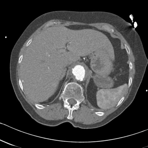File:Aortic intramural hematoma from penetrating atherosclerotic ulcer (Radiopaedia 31137-31836 A 77).jpg