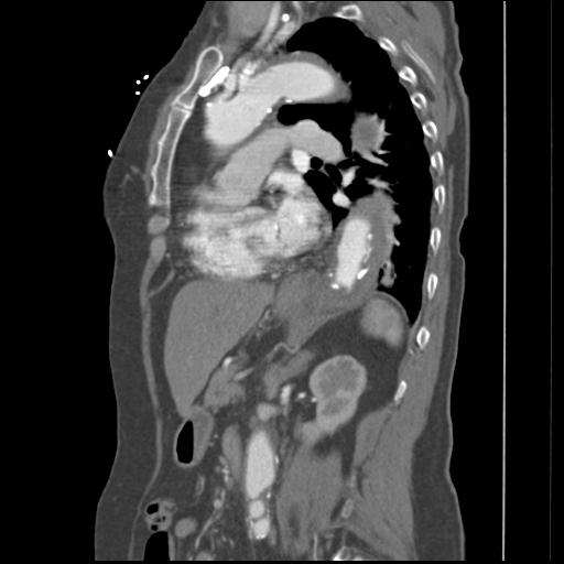 File:Aortic intramural hematoma from penetrating atherosclerotic ulcer (Radiopaedia 31137-31836 B 12).jpg