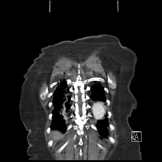 Aortic intramural hematoma with dissection and intramural blood pool (Radiopaedia 77373-89491 C 60).jpg