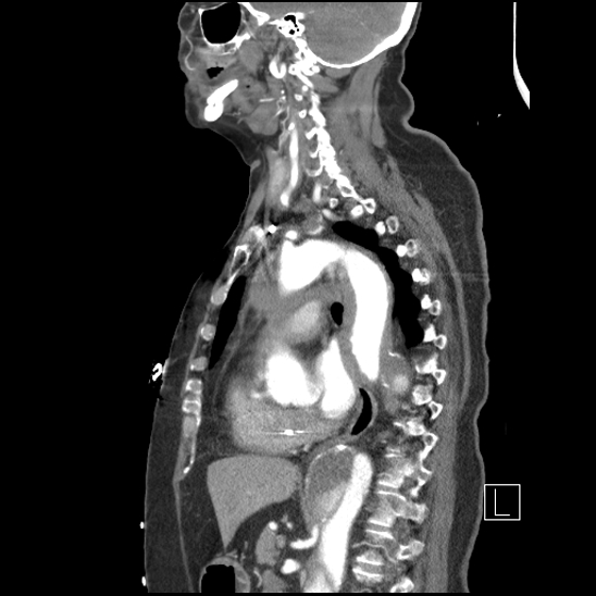Aortic intramural hematoma with dissection and intramural blood pool (Radiopaedia 77373-89491 D 49).jpg