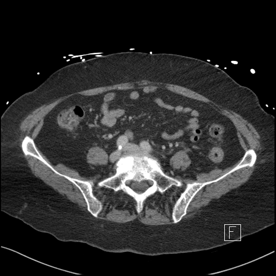 Aortic intramural hematoma with dissection and intramural blood pool (Radiopaedia 77373-89491 E 65).jpg