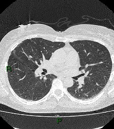 File:Aortic valve endocarditis (Radiopaedia 87209-103485 Axial lung window 51).jpg