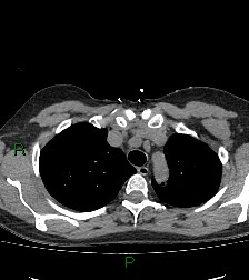 Aortic valve endocarditis (Radiopaedia 87209-103485 Axial non-contrast 25).jpg
