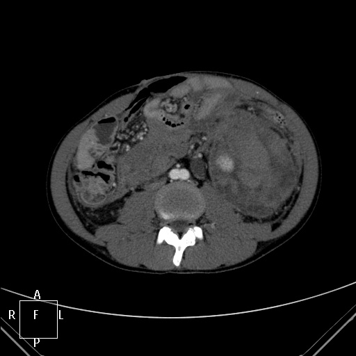File:Aorto-left renal vein fistula (Radiopaedia 45534-49628 A 38).jpg
