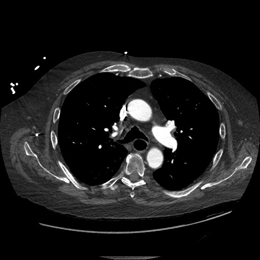 Aortoesophageal fistula with endovascular repair (Radiopaedia 73781-84592 Axial C+ CTPA 51).jpg