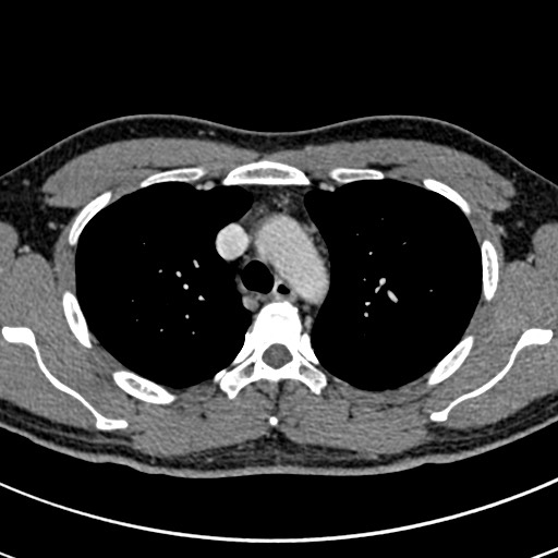 Apical lung mass mimic - neurogenic tumor (Radiopaedia 59918-67521 A 24).jpg