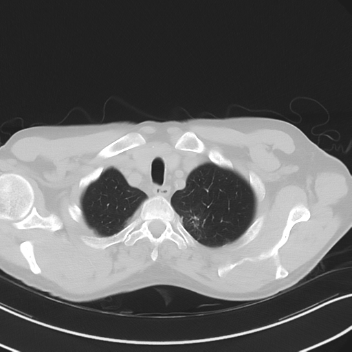 Apical pulmonary metastasis (Radiopaedia 46338-50754 Axial non-contrast 11).png