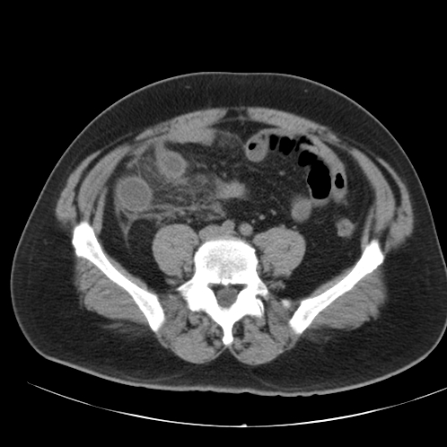File:Appendicitis and giant appendicolith (Radiopaedia 80251-93588 Axial non-contrast 38).jpg