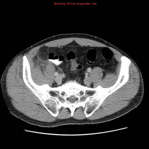 File:Appendicitis and renal cell carcinoma (Radiopaedia 17063-16760 A 44).jpg