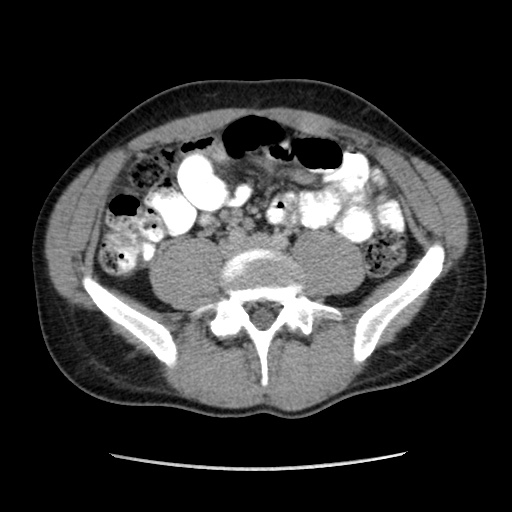 Appendicitis complicated by post-operative collection (Radiopaedia 35595-37113 A 47).jpg