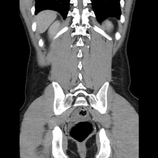 Appendicitis complicated by post-operative collection (Radiopaedia 35595-37113 B 43).jpg