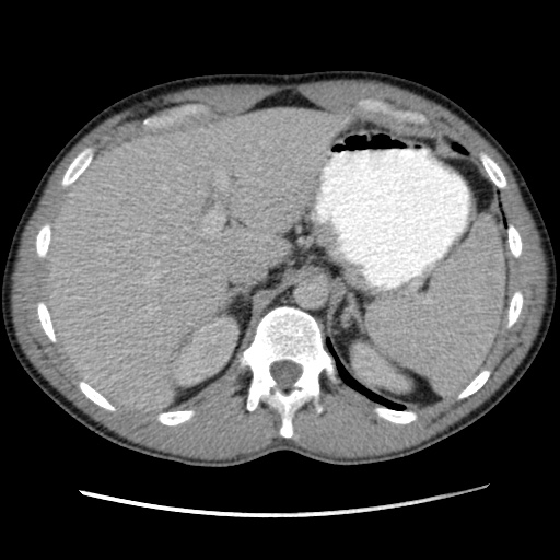 File:Appendicitis complicated by post-operative collection (Radiopaedia 35595-37114 A 21).jpg