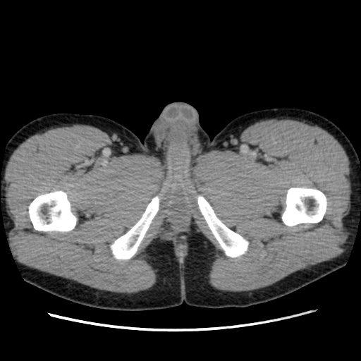 File:Appendicitis complicated by post-operative collection (Radiopaedia 35595-37114 A 96).jpg