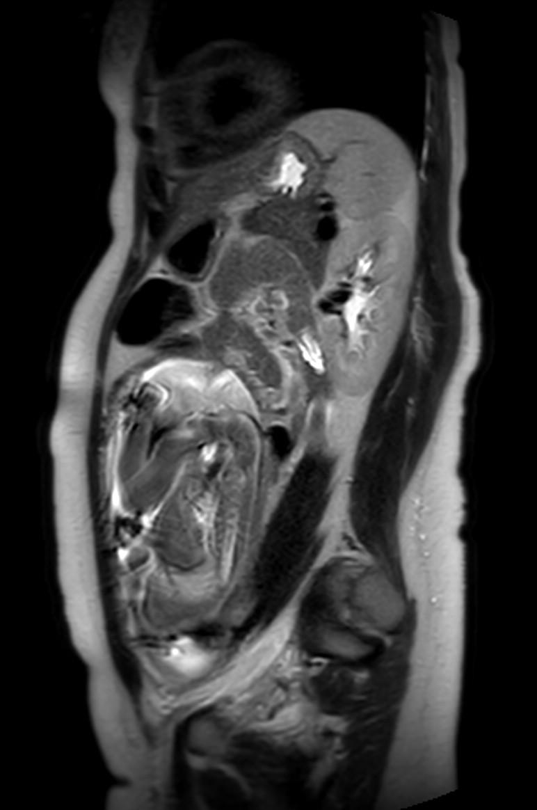 Appendicitis in gravida (MRI) (Radiopaedia 89433-106395 Sagittal T2 23).jpg