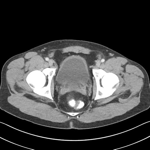 File:Appendicitis with cecal bar sign (Radiopaedia 31878-32830 B 76).jpg