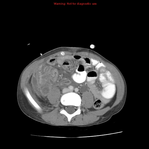 Appendicitis with phlegmon (Radiopaedia 9358-10046 A 45).jpg