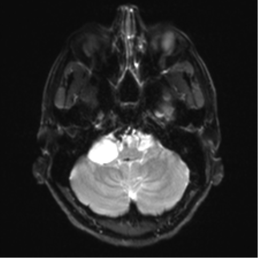Arachnoid cyst - cerebellopontine angle (Radiopaedia 59689-67083 Axial DWI 7).png