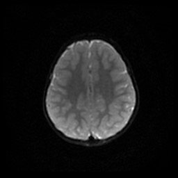 Arachnoid cyst - middle cranial fossa (Radiopaedia 86780-102938 Axial DWI 38).jpg