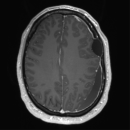 Arachnoid cyst with subdural hematoma (Radiopaedia 85892-101743 Axial T1 C+ 58).png