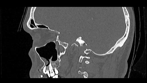 Arcuate foramen (Radiopaedia 89833-106944 Sagittal bone window 14).jpg
