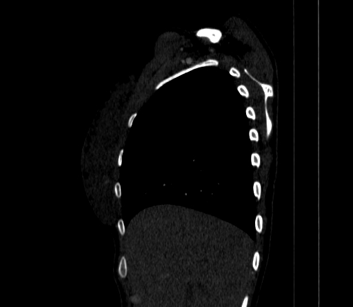 Arteria lusoria (Radiopaedia 88528-105192 C 25).jpg
