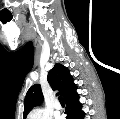 Arteriovenous malformation of the neck (Radiopaedia 53935-60062 C 44).jpg