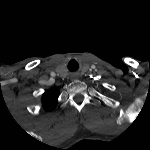 File:Artery of Percheron infarct (Radiopaedia 48088-52894 A 34).jpg