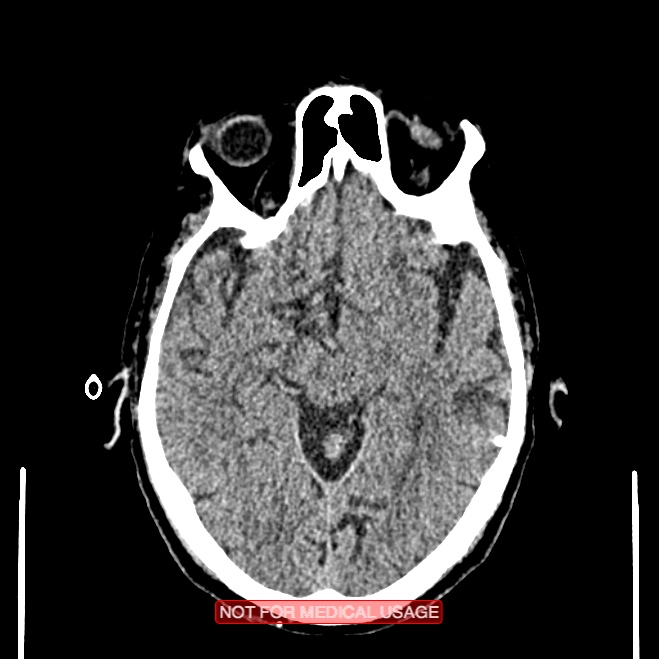 Artery of Percheron infarction (Radiopaedia 28679-28967 Axial non-contrast 51).jpg