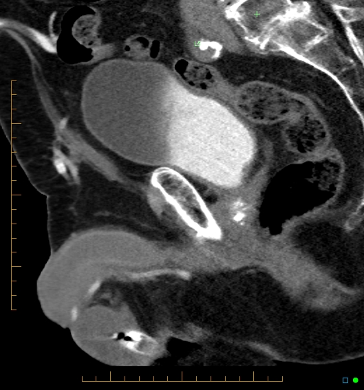 File:Artificial urethral sphincter (Radiopaedia 46937-51464 Sagittal C+ delayed 18).jpg