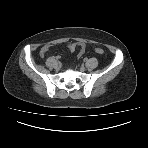 File:Ascending retrocecal appendicitis with liver abscesses (Radiopaedia 60066-67615 Axial non-contrast 64).jpg