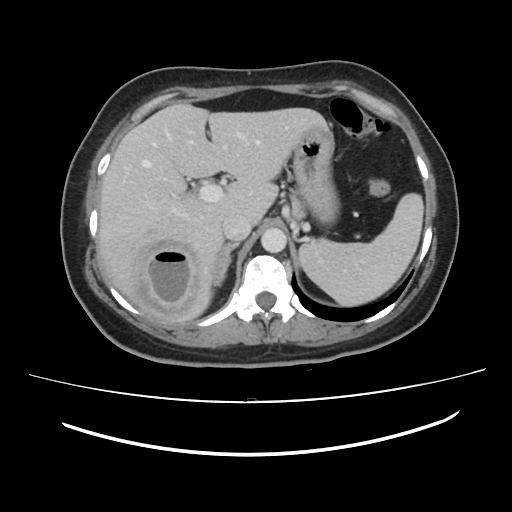 File:Ascending retrocecal appendicitis with liver abscesses (Radiopaedia 60066-67615 B 24).jpg