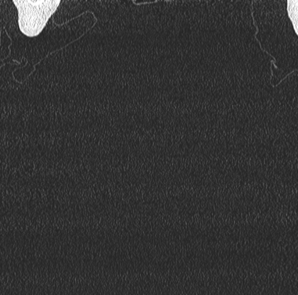 Aspergilloma- with Monod sign (Radiopaedia 44737-48532 Coronal lung window 11).jpg