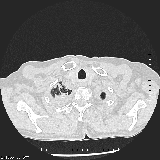 Aspergilloma (Radiopaedia 75184-86270 Axial lung window 4).jpg