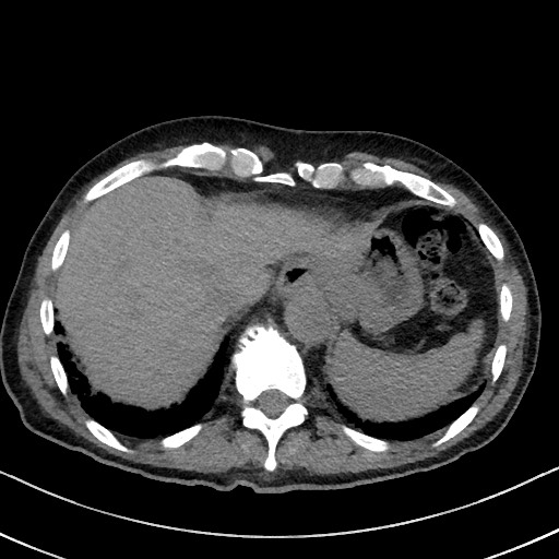 Aspergilloma on background pulmonary fibrosis (Radiopaedia 60942-68757 Axial non-contrast 49).jpg