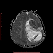 Astroblastoma (Radiopaedia 74287-85162 Axial ADC 51).jpg