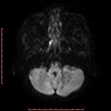 File:Astroblastoma (Radiopaedia 74287-85162 Axial DWI 13).jpg