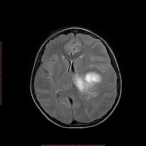 File:Astroblastoma (Radiopaedia 74287-85162 Axial FLAIR 12).jpg