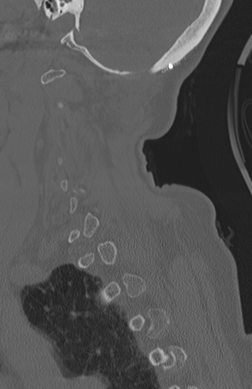 Atlanto-axial subluxation (Radiopaedia 36610-38176 Sagittal bone window 60).png
