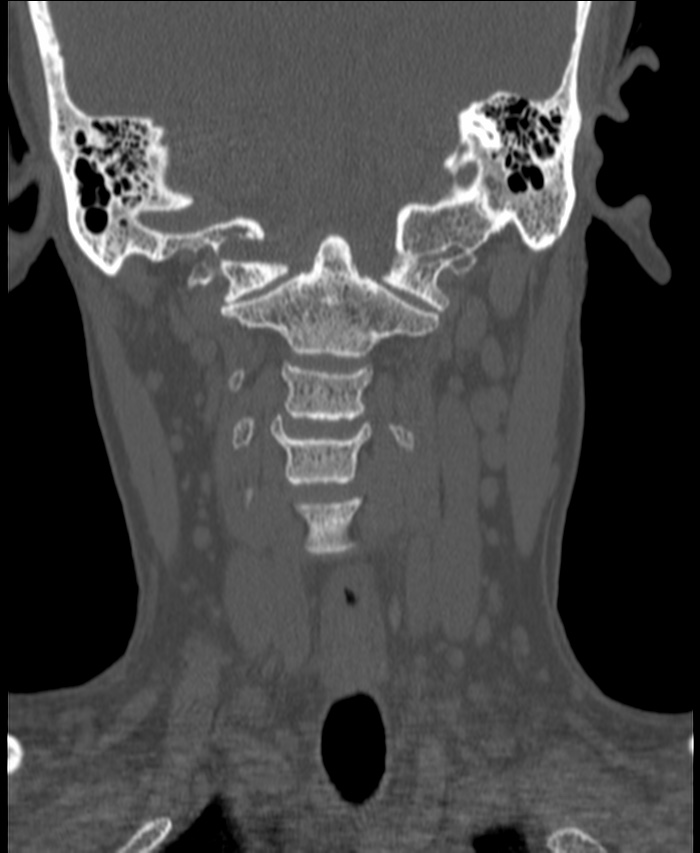 Atlanto-occipital assimilation with basilar invagination (Radiopaedia 70122-80188 Coronal bone window 83).jpg