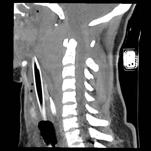File:Atlanto-occipital dislocation (Radiopaedia 44648-48412 A 14).jpg