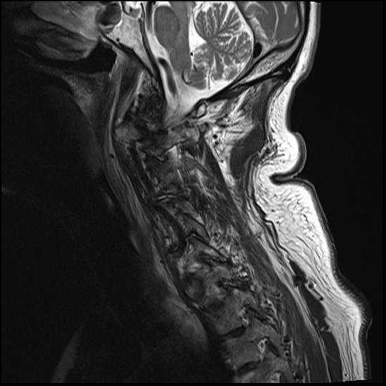 File:Atlas (type 3b subtype 1) and axis (Anderson and D'Alonzo type 3, Roy-Camille type 2) fractures (Radiopaedia 88043-104610 Sagittal T2 2).jpg